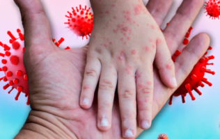 Alertan por repunte de varicela y riesgo de herpes zóster en Tabasco